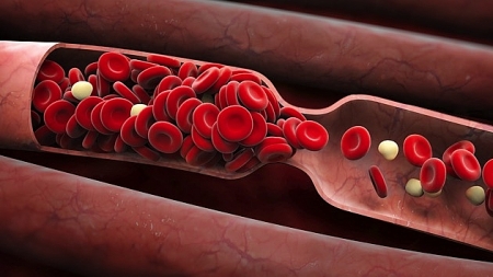 Blood clot, new deadly complication of COVID-19
