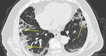 covid 19 cases are most infectious in first 7 days after developing symptoms