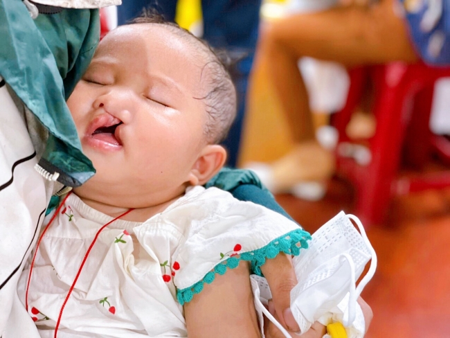 Operation Smile continues bringing smiles for Vietnam’s child patients