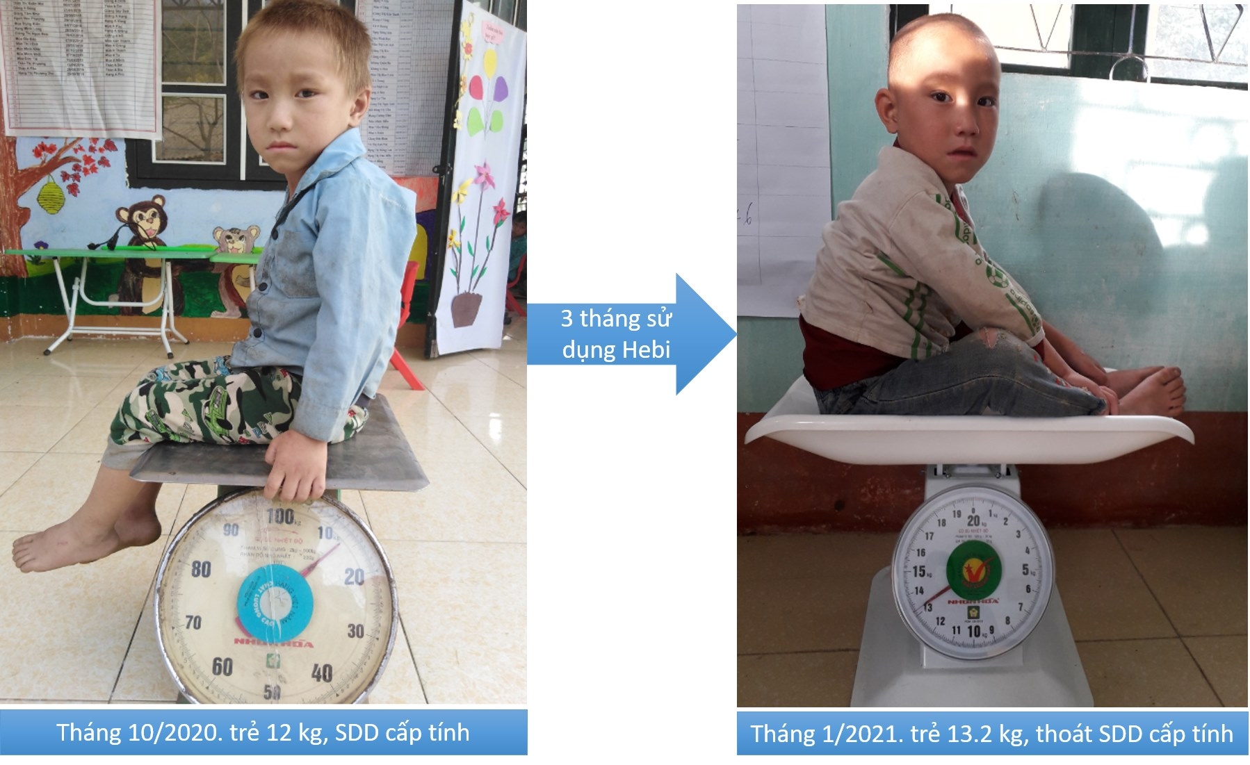 world vision supports malnourished children in dien bien province