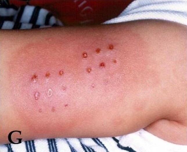 10 facts to know about kawasaki disease causes symptoms treatment link to coronavirus