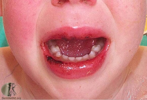 10 facts to know about kawasaki disease causes symptoms treatment link to coronavirus