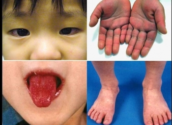 kawasaki disease causes symptoms diagnosis treatment link to coronavirus