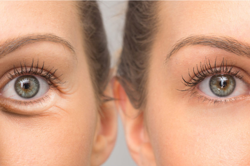 How to get rid of bags under eyes or prevent them in the first place