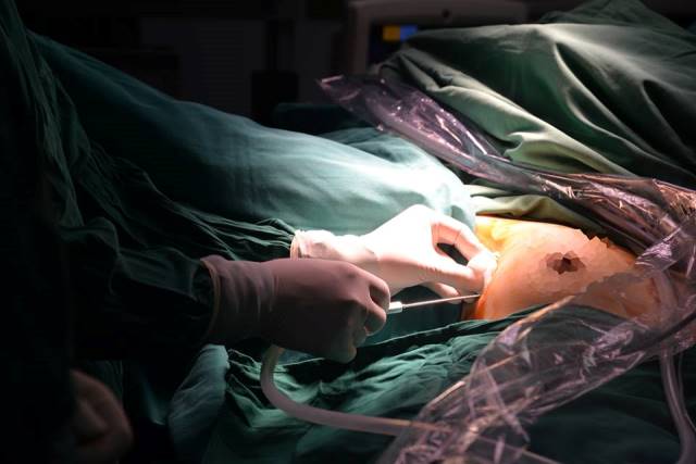 vietnam performs first successful one hole endoscopic thyroid surgery in the world